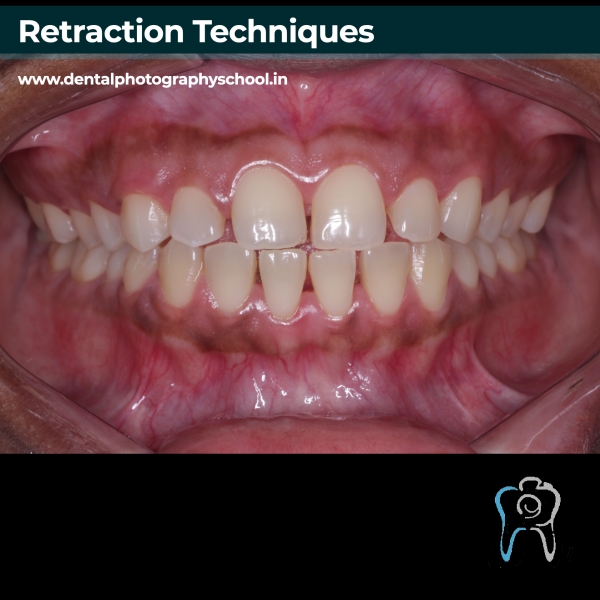 Retraction techniques in dental photography podcast